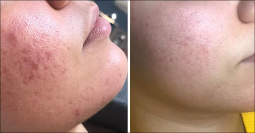 Super alternativ til Botox!